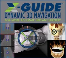 X-Guide Navigational Implant Placement
