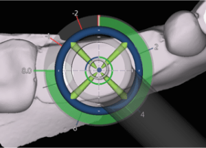 X-Guide Navigational Implant Placement image of tooth