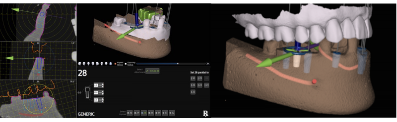 X-Guide Navigational Implant Placement image of jaw