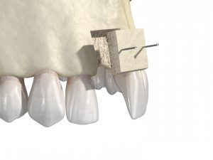 A piece of bone being attached to the front of the mouth