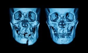 X-ray of a restored skull compared to the previous damage