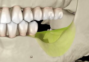 bone loss in the back of the mouth