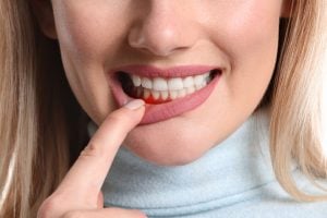 a woman showing a red spot on her gums