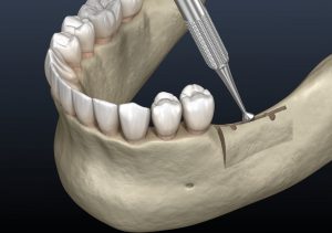 Piece of bone attached at the back of the jaw